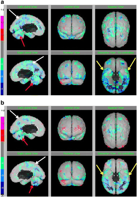 Figure 1. SPECT scan images in a 12 year old boy with autism (a) before and (b) after 80 sessions of HBOT at 1.3 atm. Legend: minus 2 (green) to minus 4 (blue) standard deviations indicate the magnitude of regional hypofunctioning (hypoperfusion). White arrows indicate improvement in deeper cortical hypoperfusion patterns. Red arrows on sagittal slices show the midline cerebellum hypoperfusion and improvements after HBOT. Yellow arrows on the “underside” view show the temporal lobe hypoperfusion with improvements after HBOT. Pictures courtesy of J. Michael Uszler, MD. Credit: Permission for use of figure from Hyperbaric Oxygen for Neurological Disorders granted by Best Publishing Company, Palm Beach Gardens, FL.