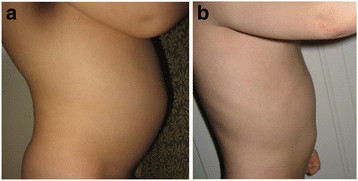 Figure 2. 6 year old boy with autism who received HBOT at 1.5 atm. Before HBOT, physical exam reveals distended abdomen (a) with chronic diarrhea. After HBOT, patient has improvements in distended abdomen (b) and bowel movements. Figure use with parental permission. Credit: Permission for use of figure from Hyperbaric Oxygen for Neurological Disorders granted by Best Publishing Company, Palm Beach Gardens, FL.