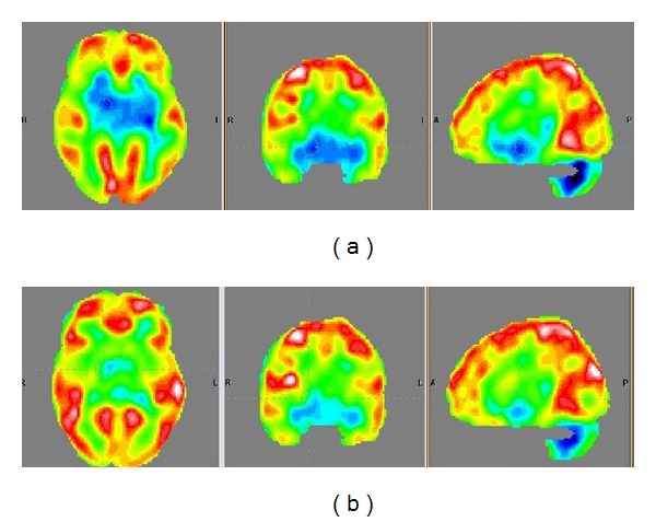 Figure 4. Findings in PET-CT scan before and after cellular therapy. (a) PET-CT scan before intervention showing reduced FDG uptake in the areas of frontal lobe, cerebellum, amygdala, hippocampus, parahippocampus, and mesial temporal lobe. (b) PET-CT scan six months after intervention comparison shows increased FDG uptake in the areas of frontal lobe, cerebellum, amygdala, hippocampus, parahippocampus, and mesial temporal lobe.