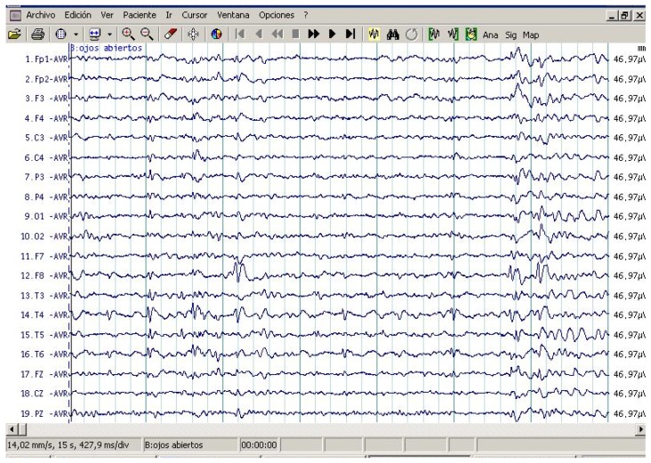 Figure 1. Routine awake electroencephalography (EEG) study in patient with ASD with epileptic seizures. Note EEG independently epileptiform abnormality in channels containing the frontal and temporal leads in both hemispheres. Maximum amplitude occurred in F8, T4, Fp1, and F3.