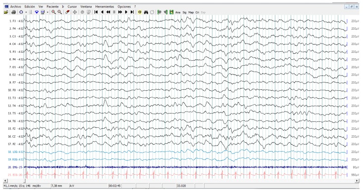 Figure 2. Sleep electroencephalography study in a patient with ASD without epileptic seizures. Recordings involve complete electroencephalogram, chin electromyography, eye movements, and electrocardiogram. Note EEG epileptiform abnormality in channels containing the right centro parieto-temporal leads, C4, P4, T4, and T6.