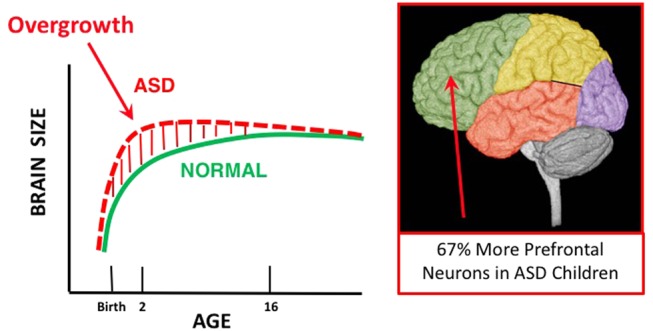 Fig. 1. Illustration of early brain overgrowth in ASD. Brain overgrowth in the first years of life occurs in many ASD toddlers and is due to prenatal cell cycle dysregulation that causes an overabundance of cortical neurons. This is theorized to lead to disrupted neural network development and function, and ASD symptoms. Unbiased, blinded stereological analyses find that young ASD male children have an average 67% more prefrontal neurons than controls. Since cortical neuron generation occurs only in prenatal life in humans, this is direct evidence that ASD begins in the womb. As discussed in this review and previously, abnormal early brain undergrowth in toddlers with ASD may also be due to cell cycle dysregulation. Adapted from Courchesne et al.