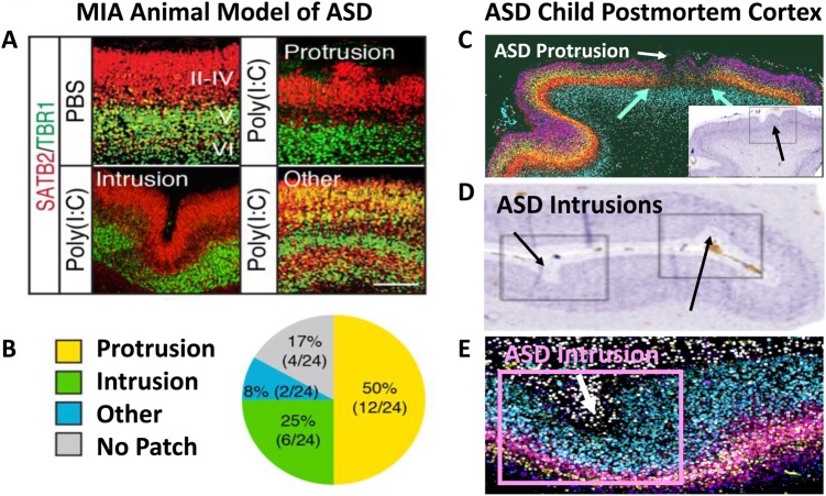 Fig. 7. In a single litter, a single prenatal poly(I:C) injection may cause different cortical layering defects across pups that resemble some types of focal cortical dysplasias seen in different individuals with ASD. a Expression of multiple layer-specific markers (II–IV and V, VI) in mouse cortex from Choi and colleagues. Typical mouse cortex layer development is shown in upper left corner (PBS), while heterogeneous types of focal cortical dysplasia are caused by prenatal maternal immune activation (MIA) by synthetic dsRNA, poly(I:C) as shown in the other three panels. b In a single litter, a single prenatal poly(I:C) injection may cause different layering defects across pups including protrusions, intrusions and laminar disorganization and other types of focal cortical dysplasia as well as pups with typical cortex. The cortical and ASD-like behavioral MIA-caused phenotypes are dependent on maternal IL-17a. c A 9 year old ASD postmortem case with ADNP gene mutation has focal macroscopic frontal cortical surface malformation (white arrow) and interruption of underlying cortical layering as visualized by expression of multiple layer-specific and cell type specific markers (see region marked by the two light blue arrows; see Fig. 1 in Stoner et al). Different marker genes represented by different colors. This focal region also has clusters of mis-migrated cells (not shown in this section). Inset shows the same cortex location visualized by nissl staining to further reveal surface undulation and protrusion (see black arrow). A 2 year old ASD postmortem case shown in d with surface intrusions visualized by nissl staining and in e with surface intrusion visualized by multiple layer-specific and cell type specific markers. Adapted from Choi et al. and Stoner et al.